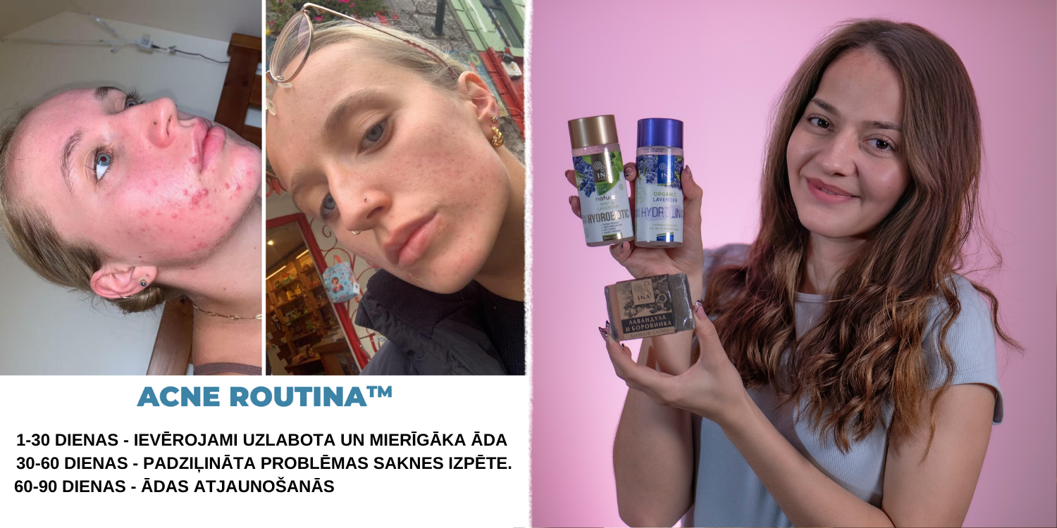 Pūtīši NEZUDZĪS, ja Jūs to Darīsiet! 5 Ikdienas Kļūdas, kas Pasliktina Pinnes (Un Kā no Tām Izvairīties!)