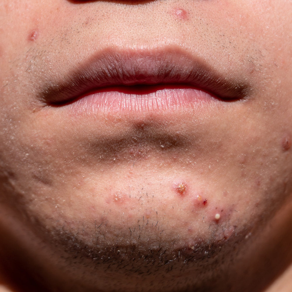 Vīrieša āda ar pinnēm: cēloņi un kopšana