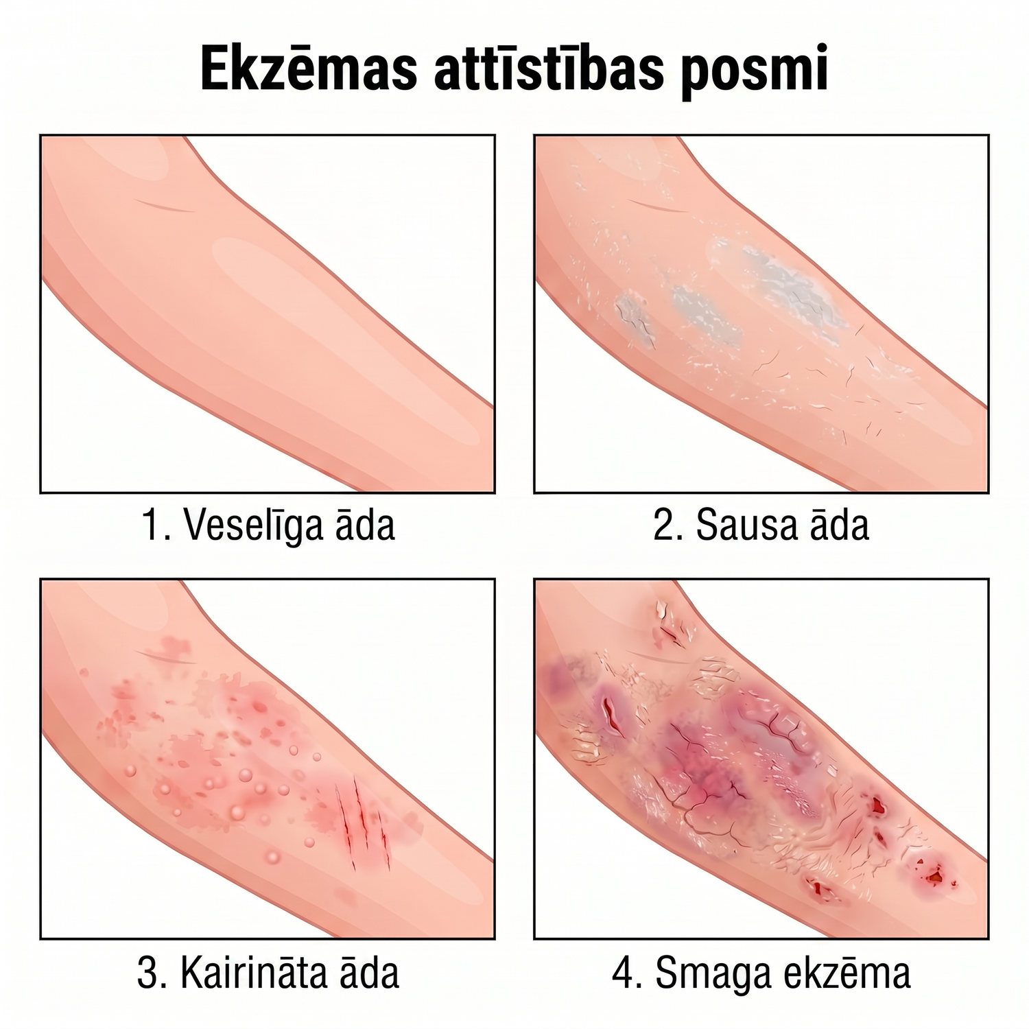 eczema_LV_eczema_4stages_v2.png
