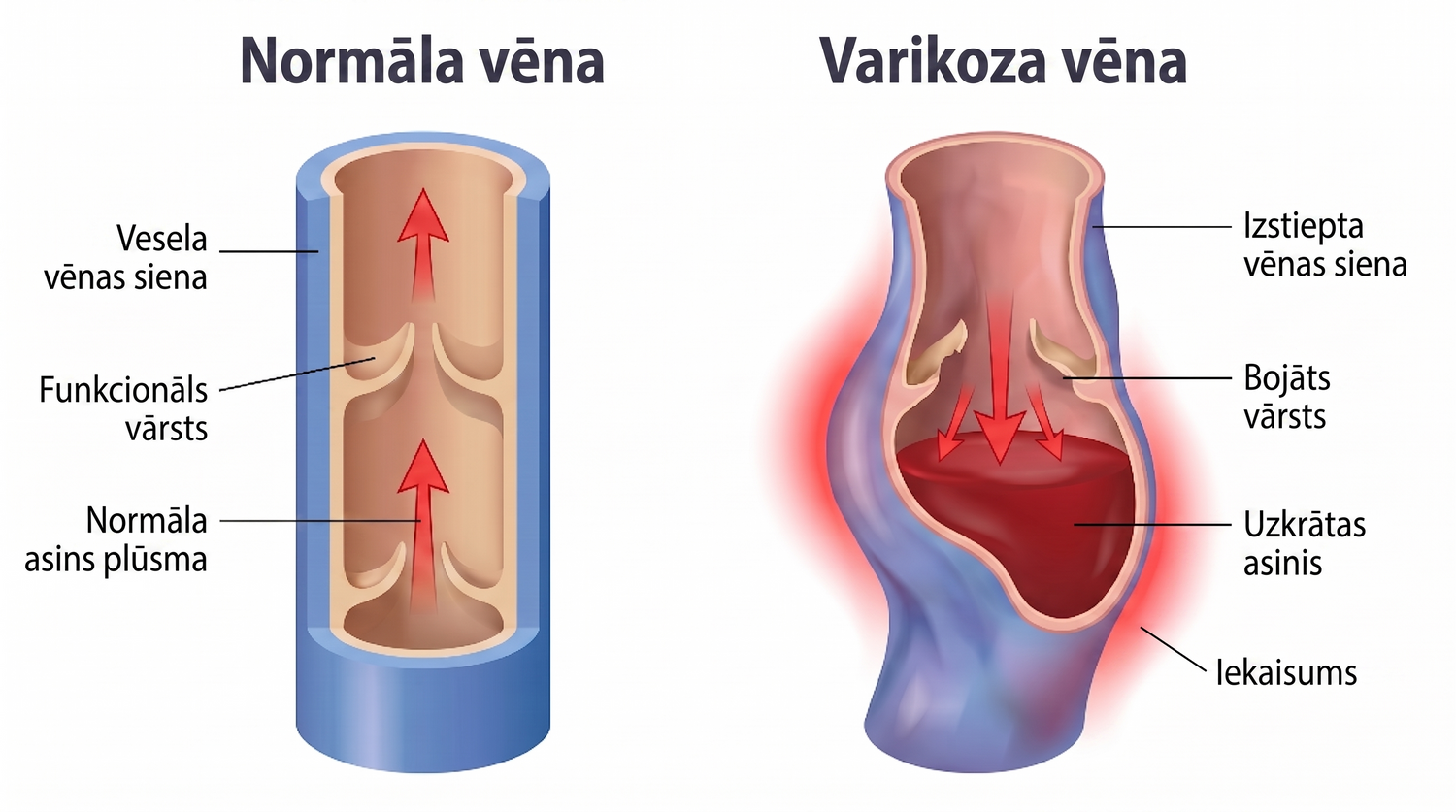 periodontis